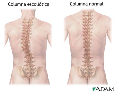 Pilates y problemas de escoliosis